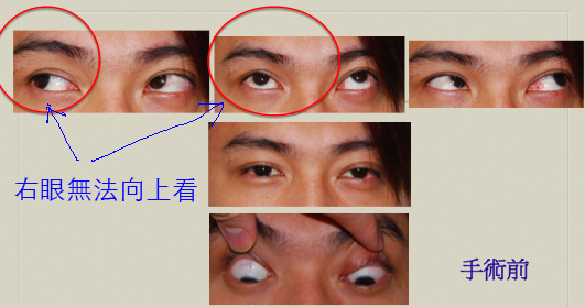 眼窩手術 眼窩骨折手術案例分享 作者 沈筠惇醫師 Dr Michael 的東方美學 沈筠惇醫師整形部落格 痞客邦