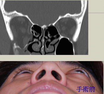 眼窩手術 眼窩骨折手術案例分享 作者 沈筠惇醫師 Dr Michael 的東方美學 沈筠惇醫師整形部落格 痞客邦