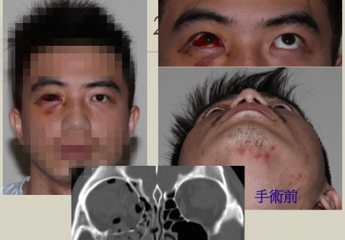 眼窩手術 眼窩骨折手術案例分享 作者 沈筠惇醫師 Dr Michael 的東方美學 沈筠惇醫師整形部落格 痞客邦