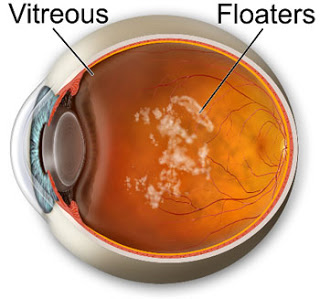 floaters-in-the-eye