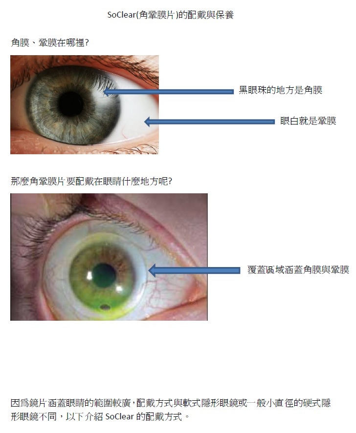 鞏膜片的配戴與照護 Eysplus 眼科 痞客邦