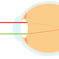 眼軸過長近視眼.png
