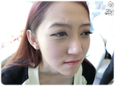 台中醫美推薦玻尿酸填補淚溝
