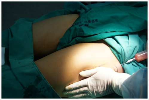 台中自體脂肪隆乳推薦自體脂肪隆乳經驗分享 台中自體脂肪隆乳推薦自體脂肪隆乳經驗分享