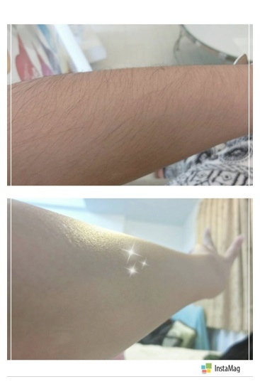 雷射除毛 雷射除毛