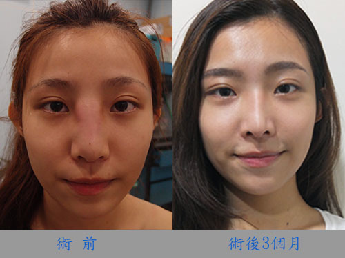 隆鼻失敗大救星二次進場靠專業醫師自體肋骨隆鼻重建自然美鼻 醫美整形大觀園 痞客邦 隆鼻失敗大救星二次進場靠專業醫師自體肋骨隆鼻重建自然美鼻 醫美整形大觀園 痞客邦