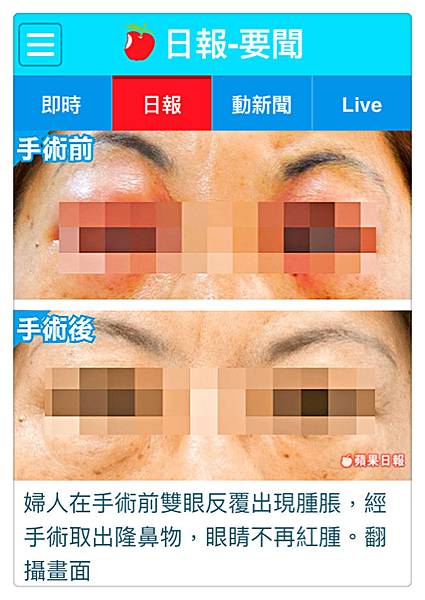 隆鼻30年 婦眼腫如被家暴