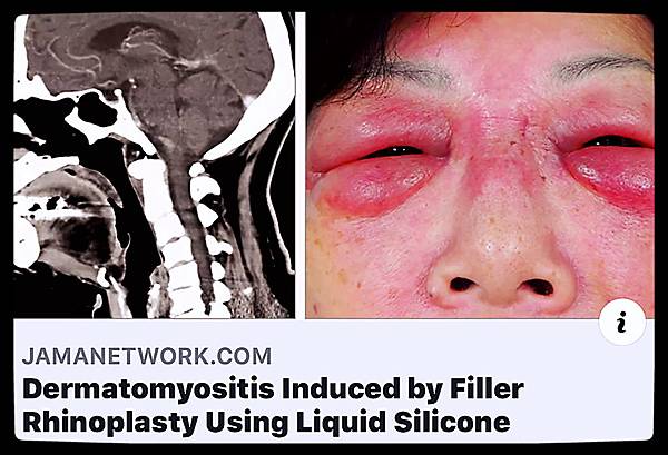 邱昱勳醫師論文Dermatomuositis induced by filler rhinoplasty using liquid silicone.jpg