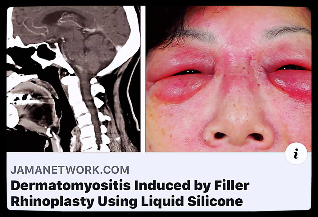 邱昱勳醫師論文Dermatomuositis induced by filler rhinoplasty using liquid silicone.jpg