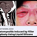 邱昱勳醫師論文Dermatomuositis induced by filler rhinoplasty using liquid silicone.jpg