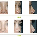 兩段式隆鼻案例 - 43.jpg