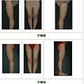 腿部抽脂案例 - 5.jpg