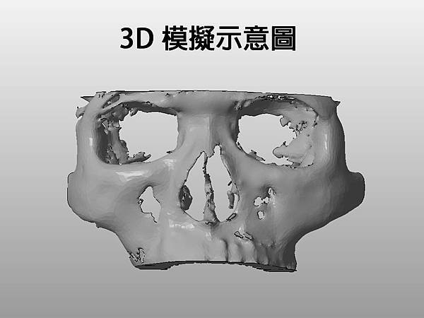 3D圖鼻雕手術01.jpg