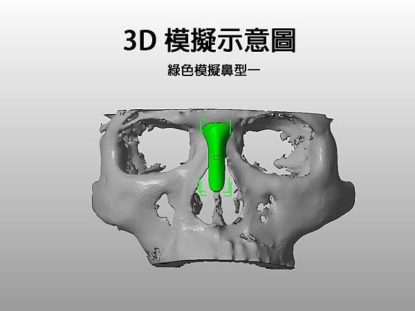 3D圖鼻雕手術03.jpg