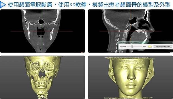 3D設計鼻雕手術.jpg