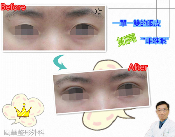一單一雙的雌雄眼 健康醫療資訊網 痞客邦