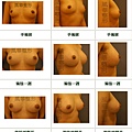 隆乳案例 - 1.jpg