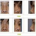 兩段式隆鼻案例 - 7.jpg