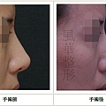 二次鼻雕手術案例 - 6.jpg