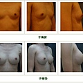 隆乳案例 - 5.jpg