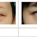 雙眼皮案例 - 5.jpg