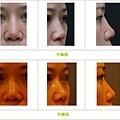 兩段式隆鼻案例 - 39.jpg