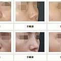 隆鼻案例 - 6.jpg