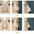 二次鼻雕手術案例 - 7.jpg