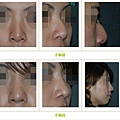 二次鼻雕手術案例 - 9.jpg