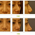 二次鼻雕手術案例 - 8.jpg