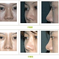 兩段式隆鼻案例 - 24.jpg