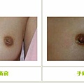 乳頭凹陷案例 - 3.jpg