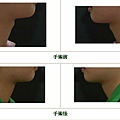喉結縮減案例 - 3.jpg