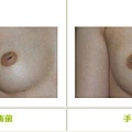 乳頭凹陷案例 - 2.jpg