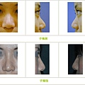 兩段式隆鼻案例 - 34.jpg