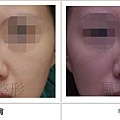 二次鼻雕手術案例 - 4.jpg