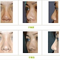 兩段式隆鼻案例 - 4.jpg