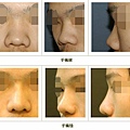 隆鼻案例 - 3.jpg