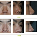 兩段式隆鼻案例 - 30.jpg