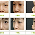 兩段式隆鼻案例 - 17.jpg