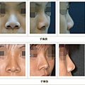 隆鼻案例 - 2.jpg