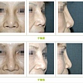 二次鼻雕手術案例 - 11.jpg