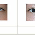 雙眼皮案例 - 11.jpg