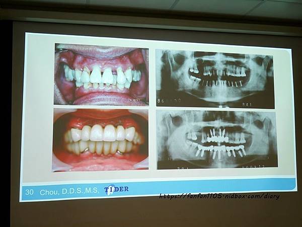【台北牙醫推薦】來德牙醫診所 #周承澤醫師 #人工植牙 (19).JPG