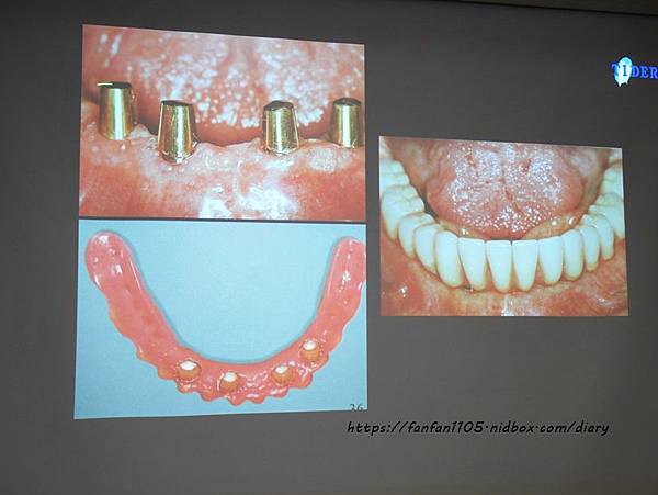 【台北牙醫推薦】來德牙醫診所 #周承澤醫師 #人工植牙 (20).JPG