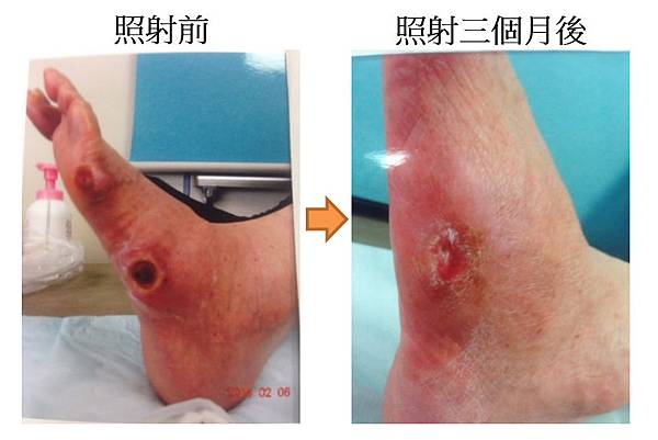 糖尿病傷口-井尾.jpg 糖尿病傷口-井尾.jpg