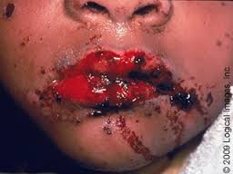 史帝芬強生症候群 Stevens Johnson Syndrome 簡稱sjs 與毒性表皮壞死溶解症 Toxic Epidermal Necrolysis 簡稱ten Farmaceut的胡言亂語醫藥倉儲中心 痞客邦