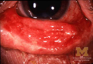 Stevens-Johnson_Syndrome_Conjunctivitis.jpg