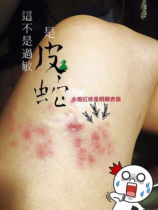 帶狀皰疹 皮蛇 讓你痛不欲生 菲堤舒療美顏館 這可不是普通沙龍 網友推薦全程不推銷 台南做臉 身體按摩好去處 痞客邦