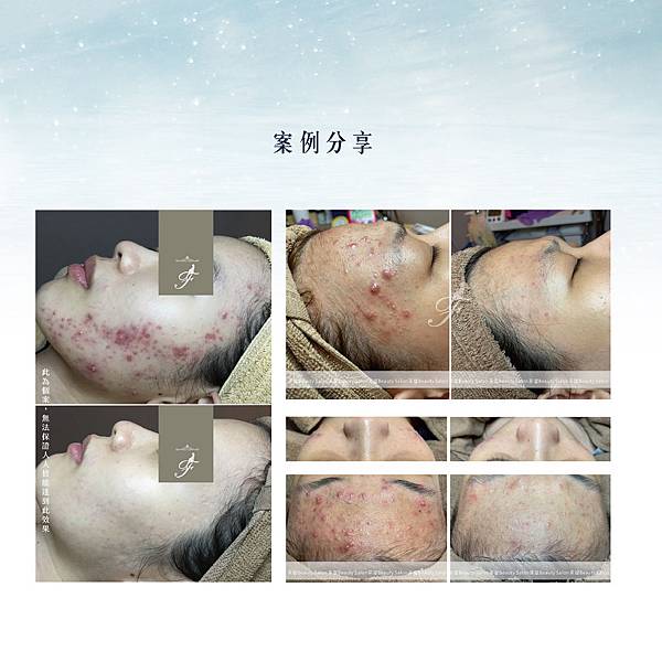 菲堤舒療美顏,PTT網友推薦台南做臉不推銷第一品牌,VLB熱 菲堤舒療美顏,PTT網友推薦台南做臉不推銷第一品牌,VLB熱